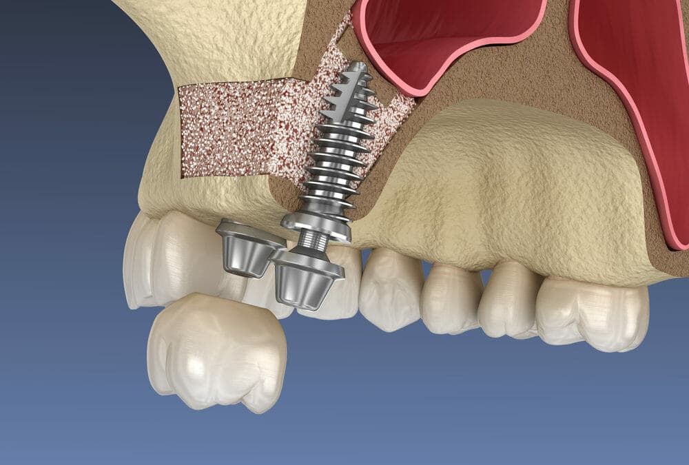 Bone Graft & Sinus Lift