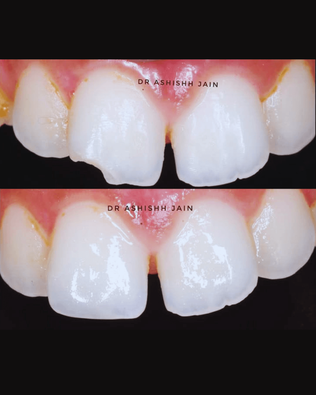 Tooth-Colored Fillings